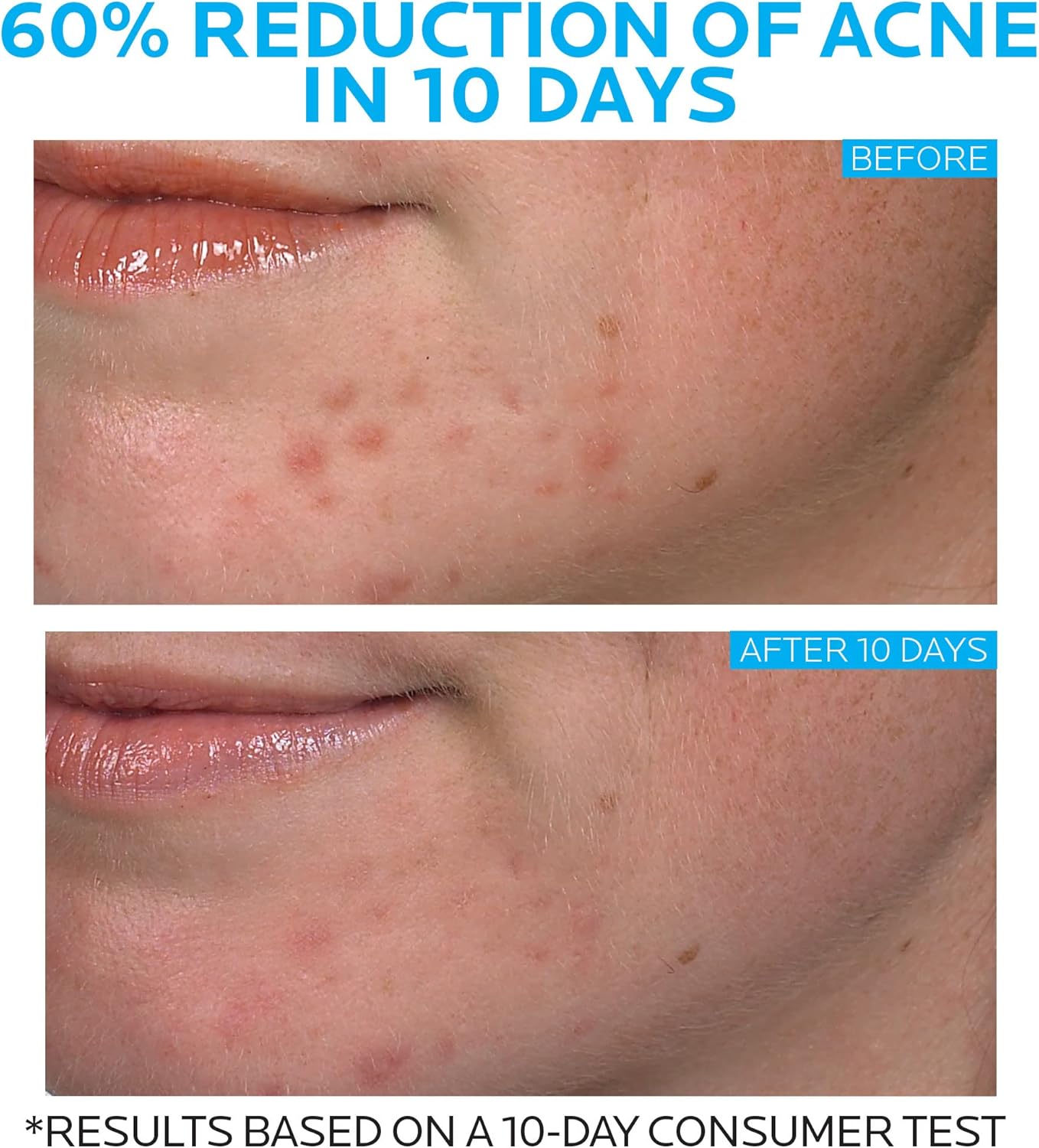 La Roche-Posay Effaclar Duo acne treatment 20ml bottle for face