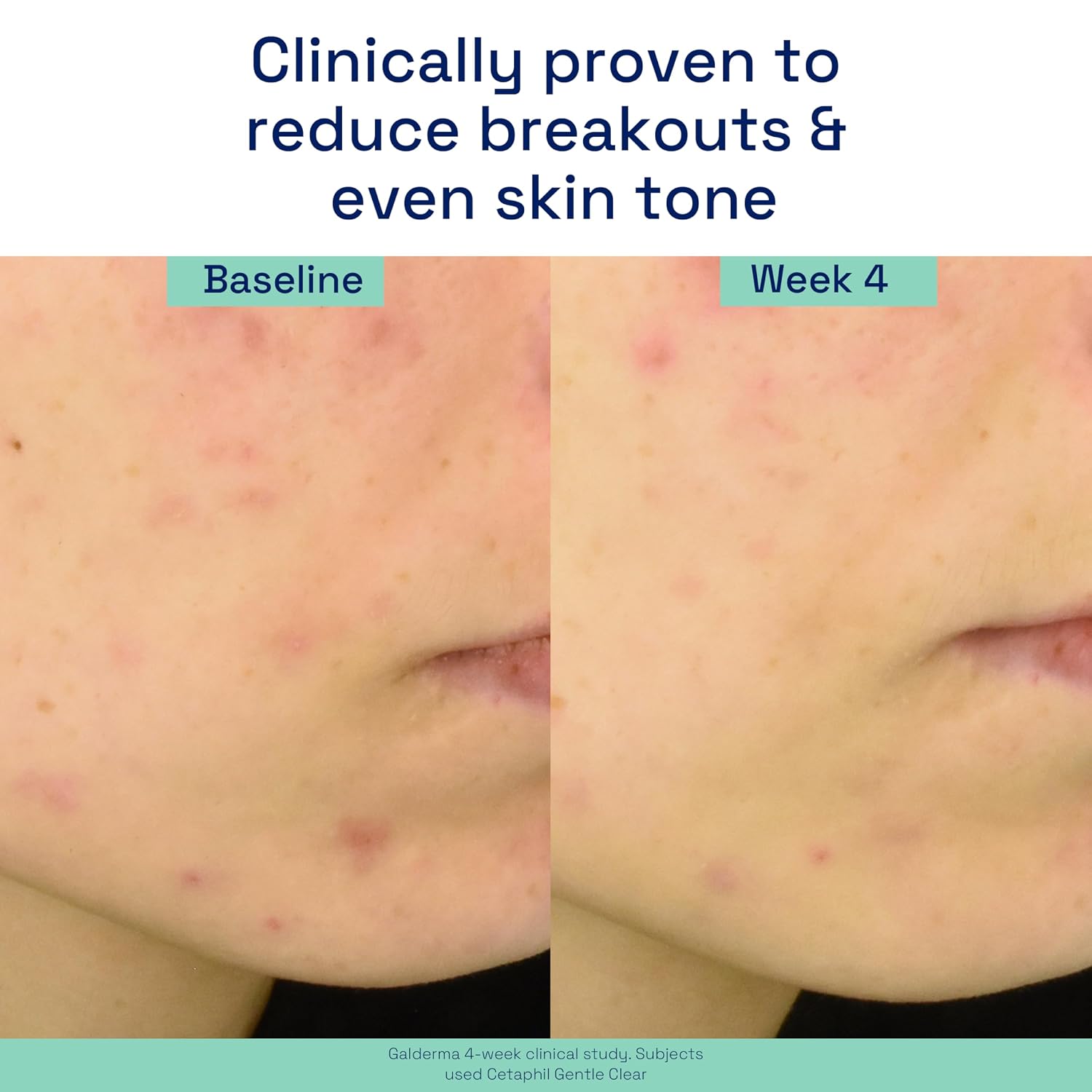 Cetaphil Gentle Clear Acne Serum Salicylic Acid Treatment, 1oz | Triple-Action Acne Serum, Treats And Prevents Breakouts, Fades Post-Acne Marks, Salicylic. — photo 4