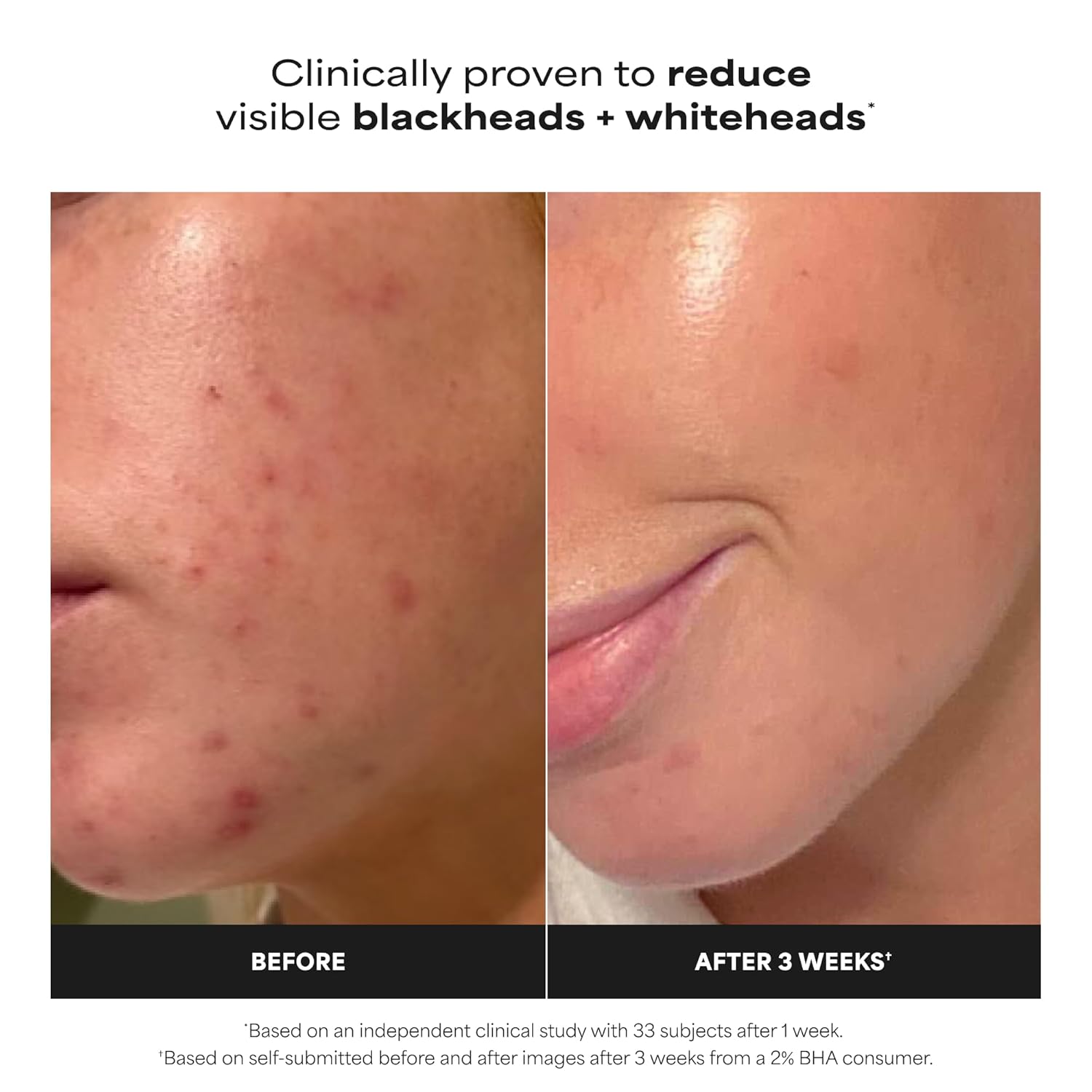 Paula's Choice Skin Perfecting 2% BHA Liquid Exfoliant 30ml SEO Content — photo 5