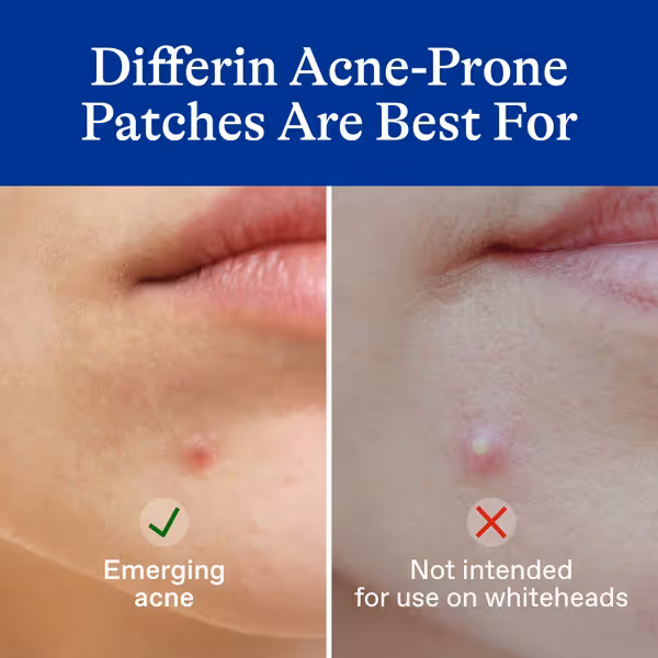 Differin Fast Fix Salicylic Acid Pimple Patches (36-count pack), — photo 4